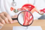 Endométriose : définition, symptômes et comment la soulager au quotidien 8 endométriose